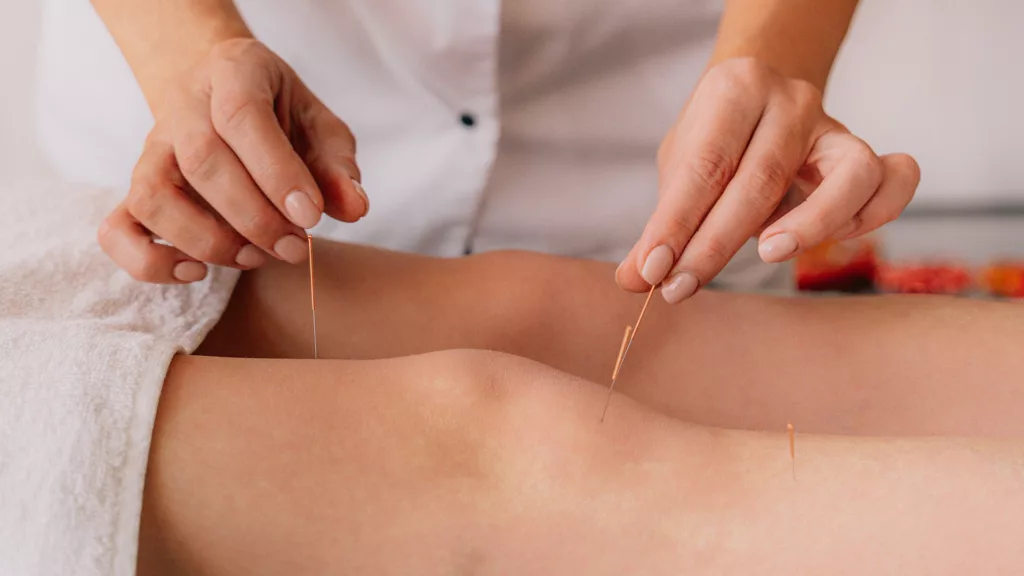 Acupuncture treatment for pain relief and musculoskeletal tension using Balance Method Acupuncture techniques