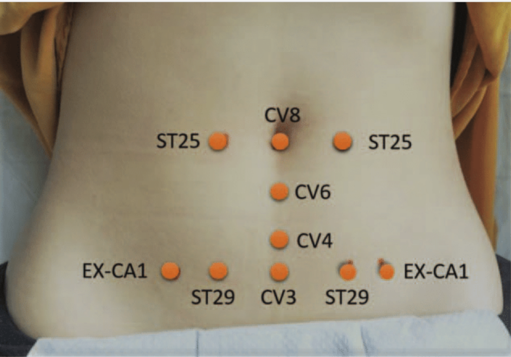 Acupuncture points commonly associated with women’s health, fertility, and hormonal balance in classical Chinese medicine